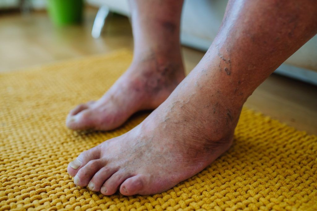 Swollen legs with varicose veins & diabetic neuropathy on yellow rug