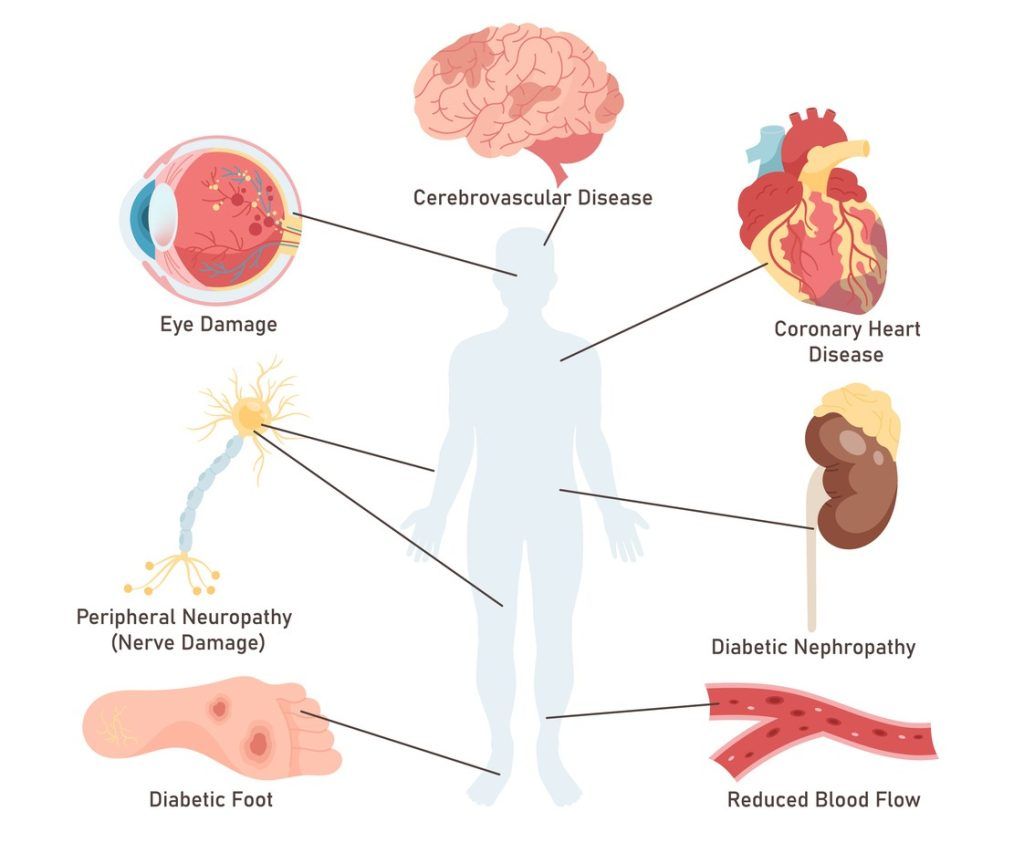 Illustrated image showing the complications of diabetes.
